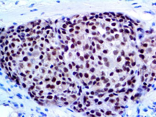 SOX-10 Antibody Immunohistochemistry on a FFPE Melanoma Tissue